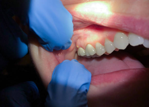 Best Emergency Dentist for Lost Fillings or Crowns in West Falls Church, VA