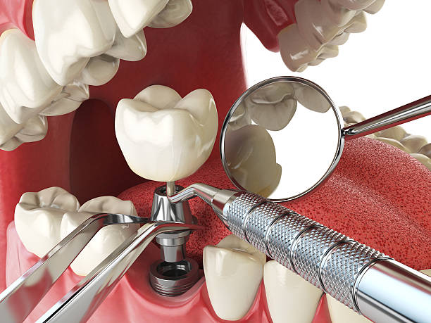 Best Emergency Root Canal Treatment in West Falls Church, VA