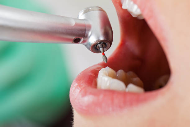 Best Emergency Dental Care for Abscessed Tooth in West Falls Church, VA